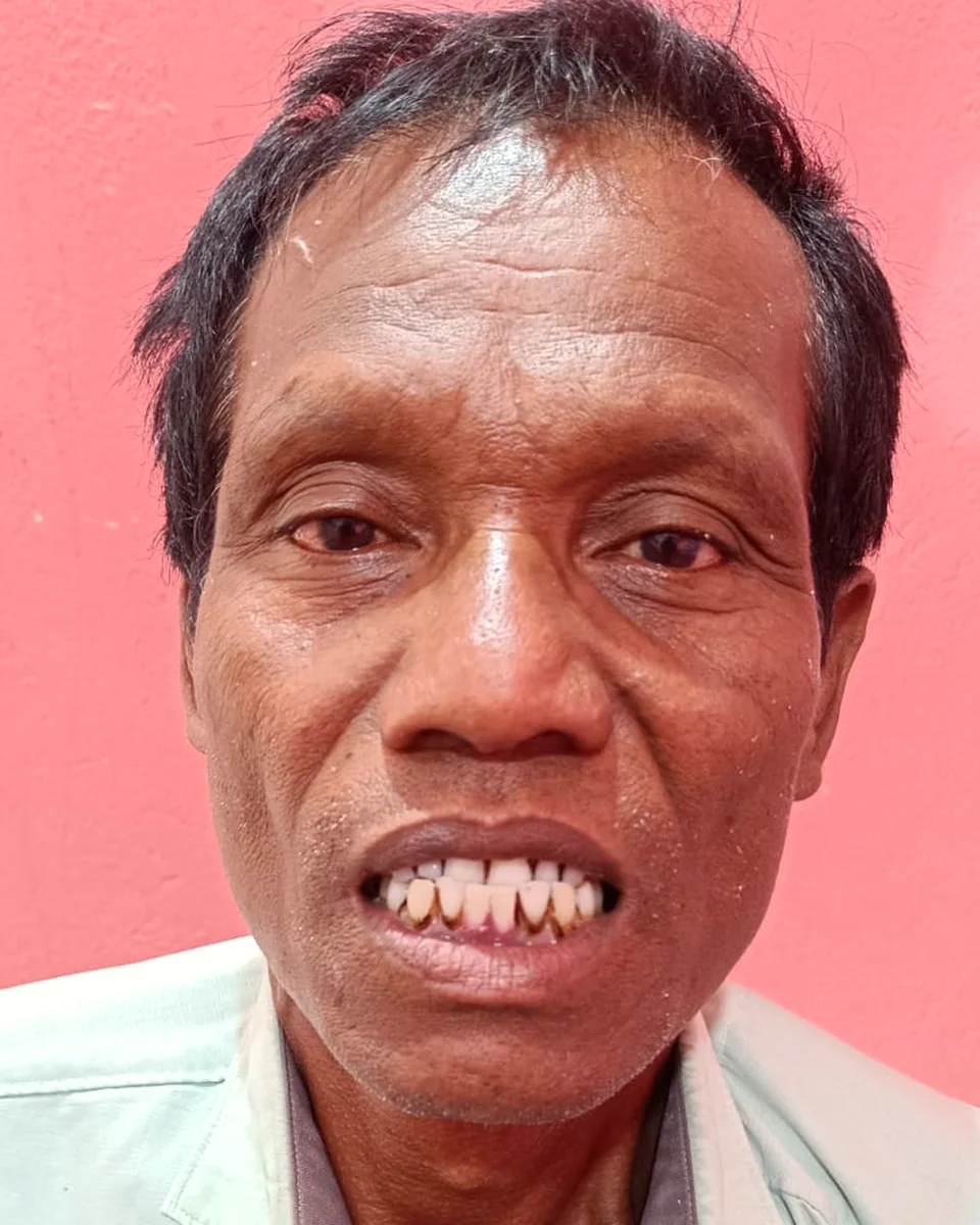 After: Rebuilt to match his other teeth
