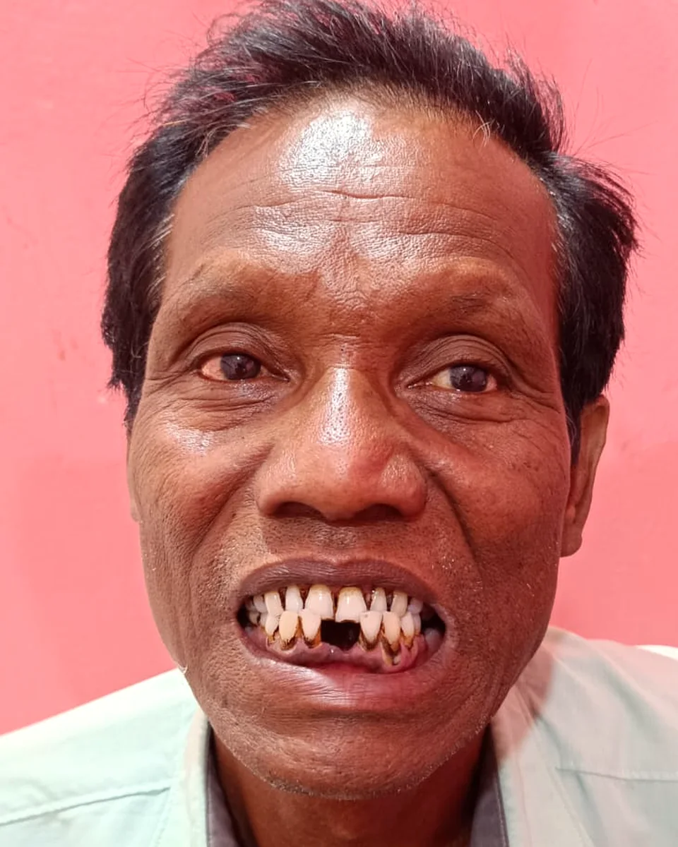 Before: Broken front tooth