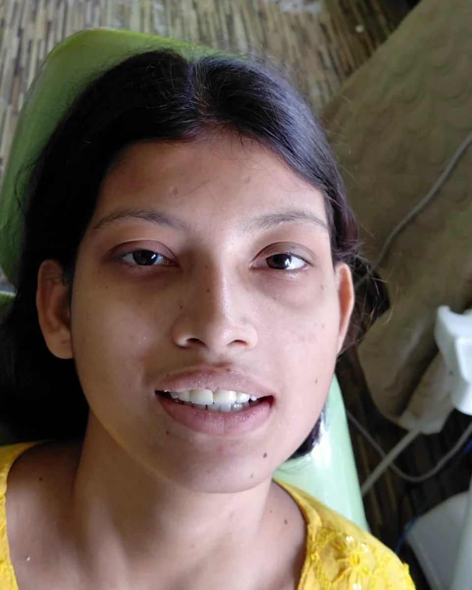 After: Filled in a natural tooth shade
