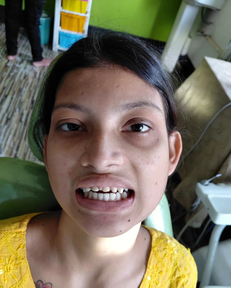 Before: Gaps and decay on front teeth