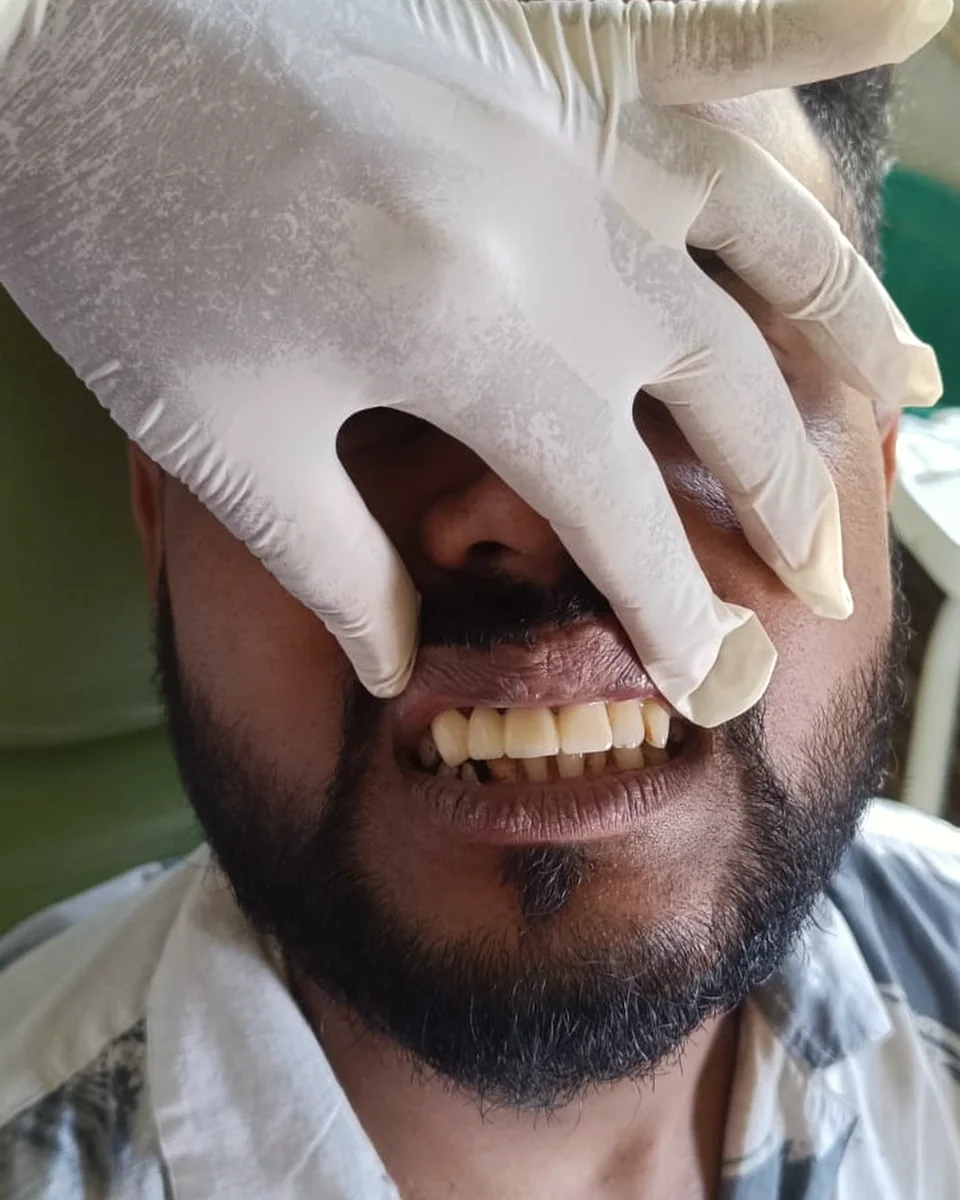 After: Front teeth replaced