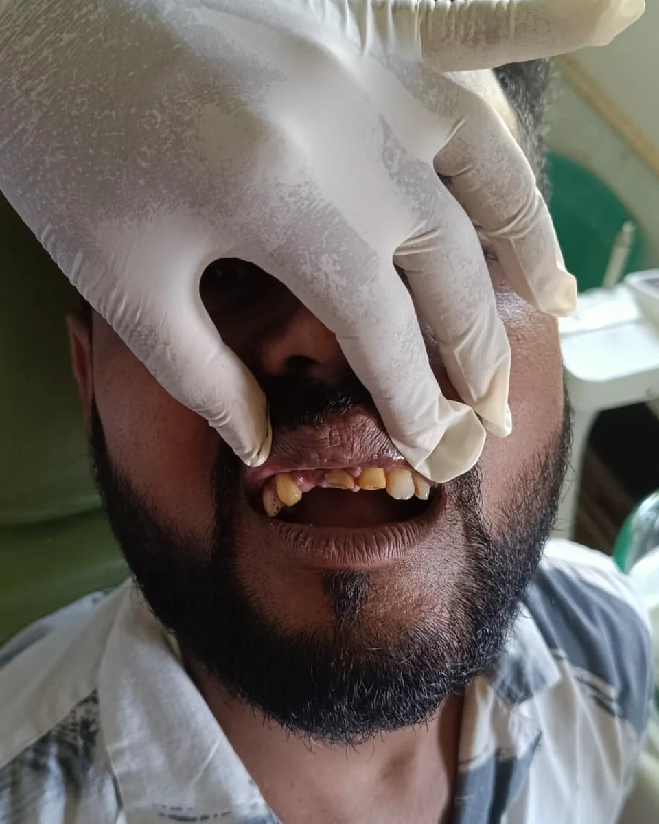 Before: Broken, decayed front teeth