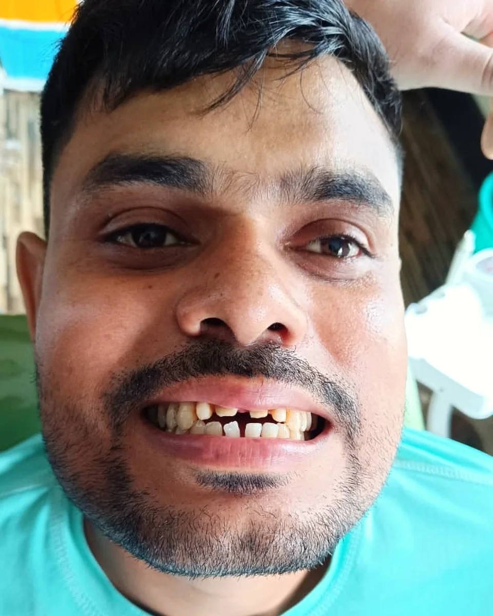 Before: Chipped, uneven front teeth